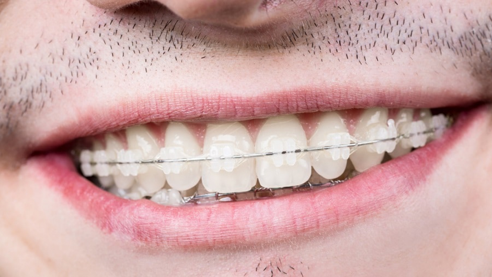 دلیل کج شدن دندانها