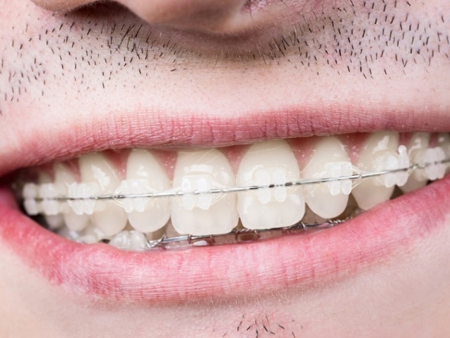 دلیل کج شدن دندانها